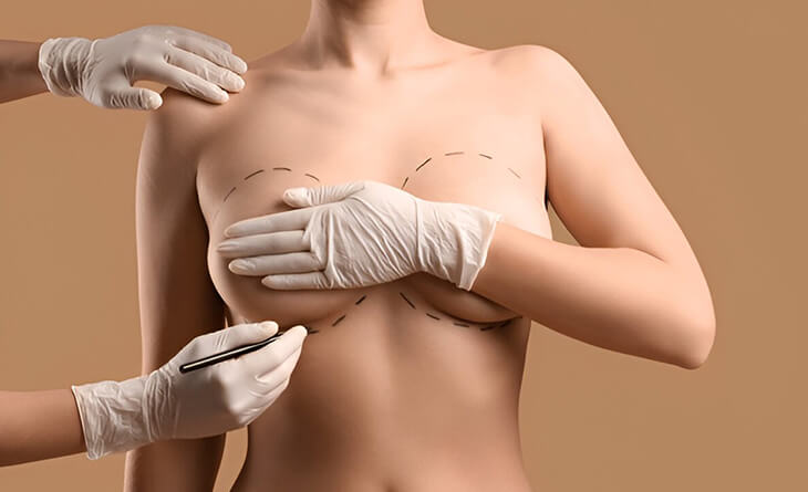 Breast Lift Surgery