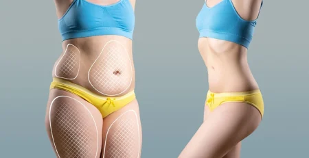 Liposuction Surgery