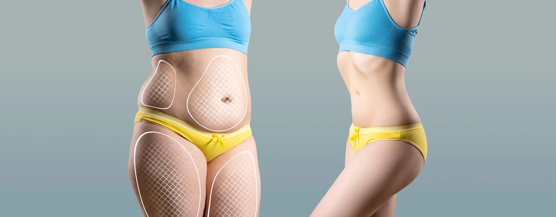 Liposuction Surgery