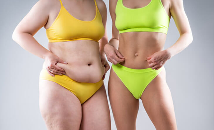 Liposuction Surgery