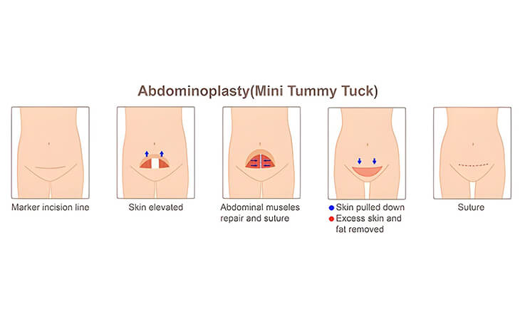 Tummy Tuck Surgery