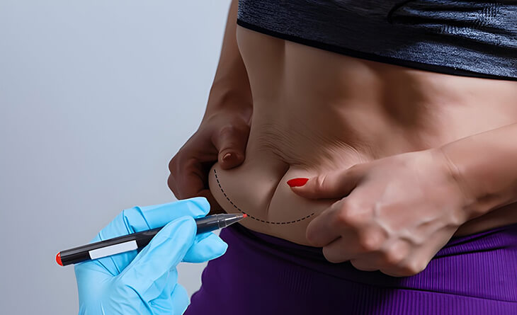 Tummy Tuck Surgery