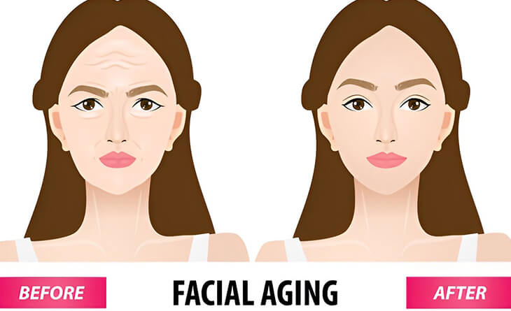 Facelift Surgery