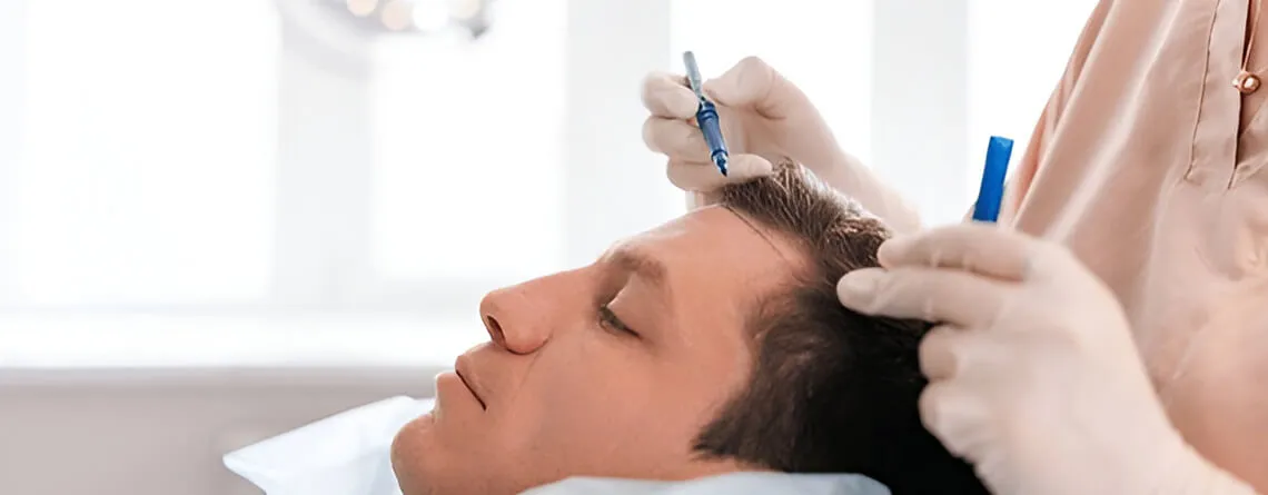 Hair Transplant in India