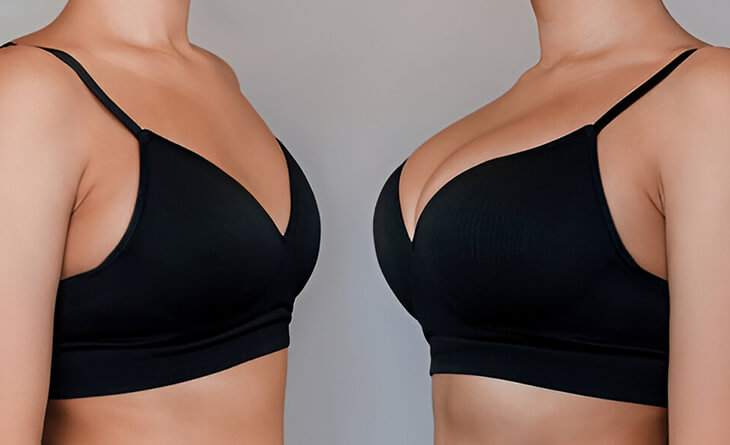 breast lift surgery