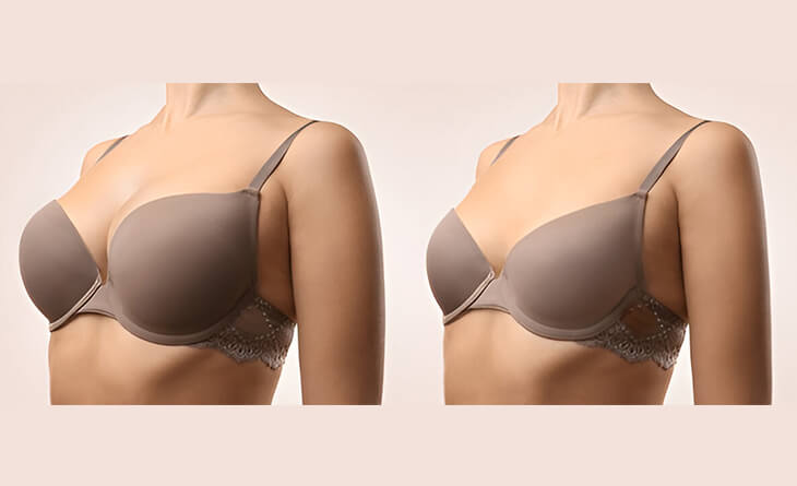 breast reduction surgery