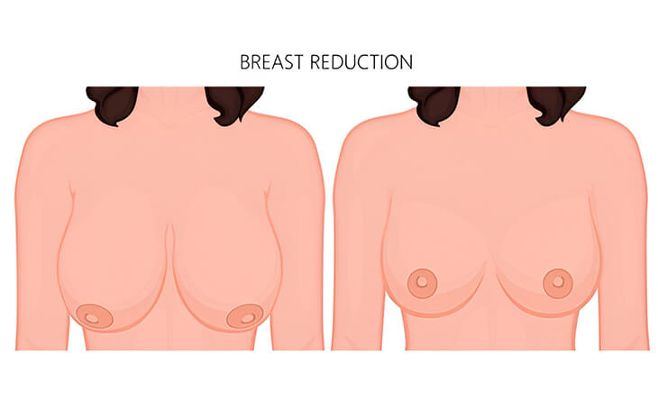 Breast Reduction Surgery