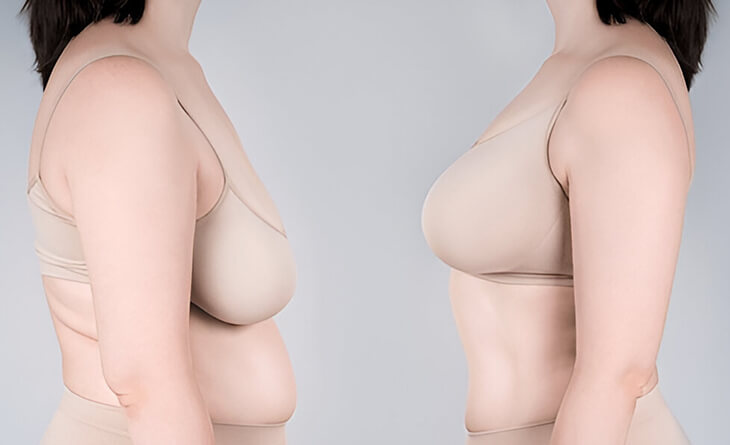 Breast Reduction Surgery