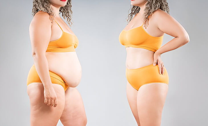 Liposuction surgery