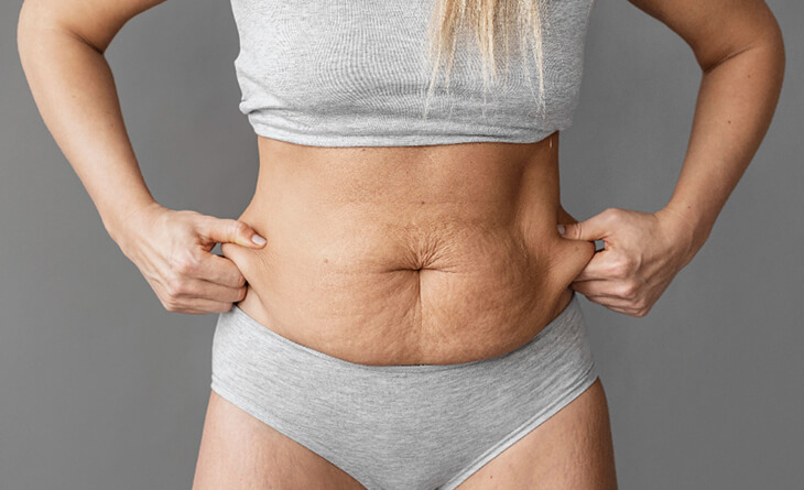 Tummy Tuck Surgery