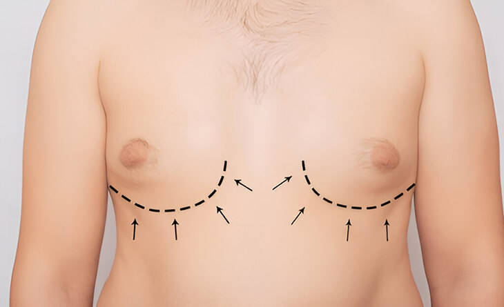 Gynecomastia surgery