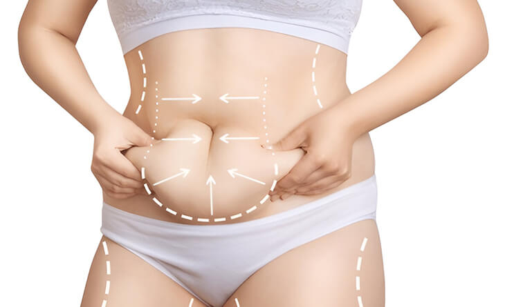 Liposuction Surgery