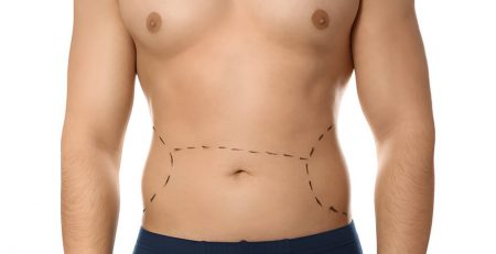 Tummy Tuck for Men