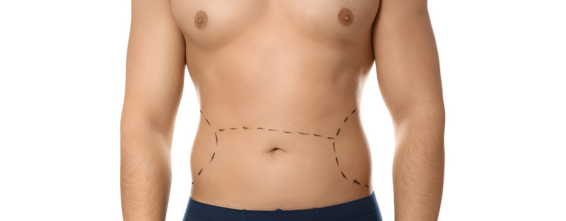 Tummy Tuck for Men