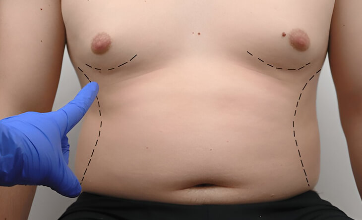 Tummy Tuck for Men