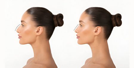 Rhinoplasty Surgery