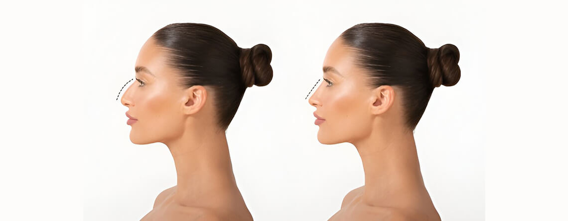 Rhinoplasty Surgery