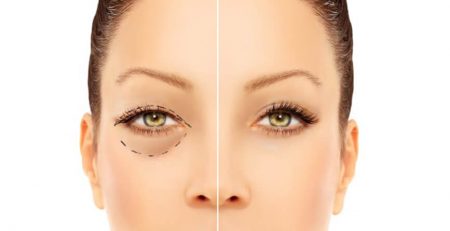 Blepharoplasty Surgery