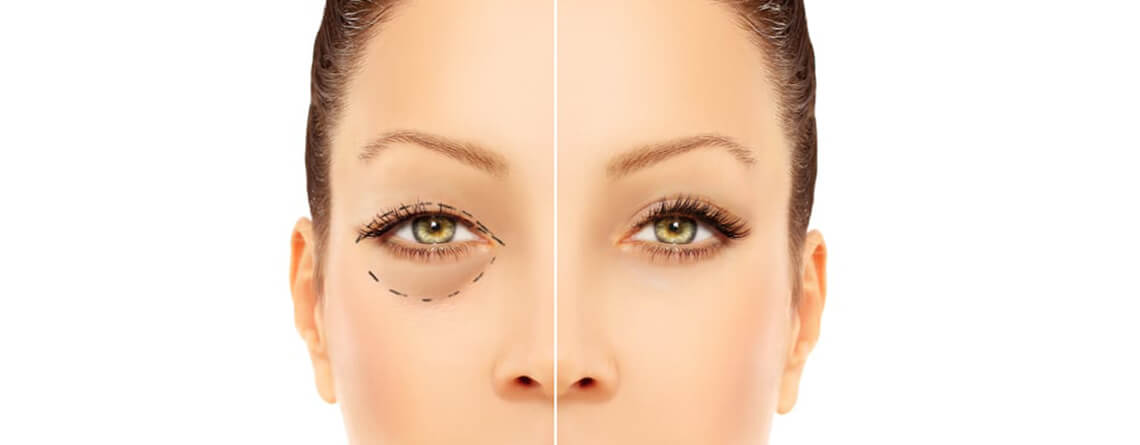 Blepharoplasty Surgery