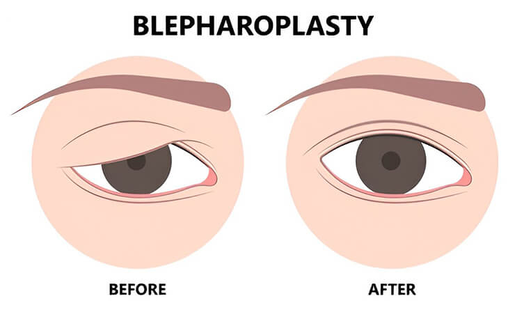 Blepharoplasty Surgery