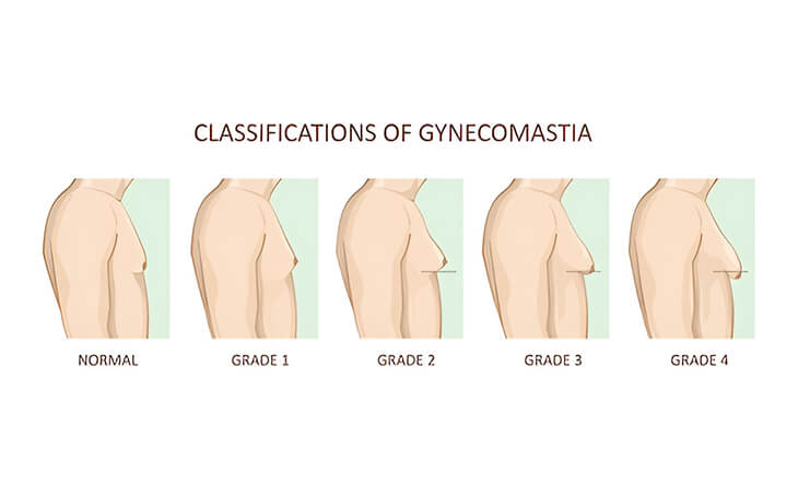 Gynecomastia Surgery