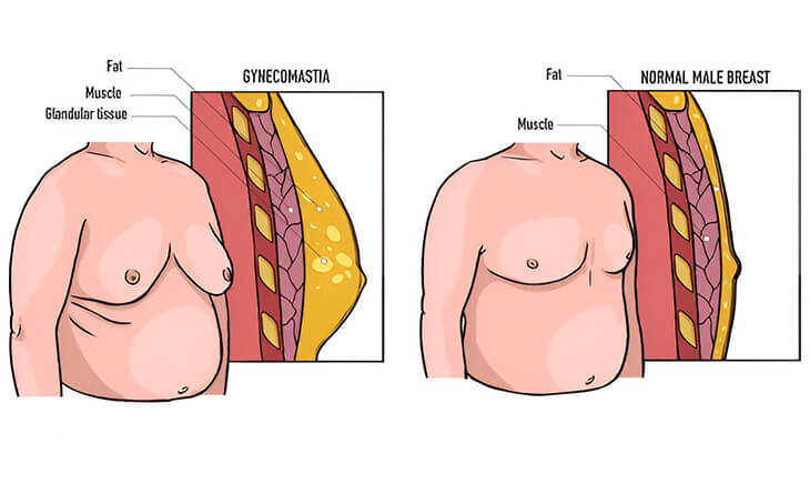 Gynecomastia Surgery