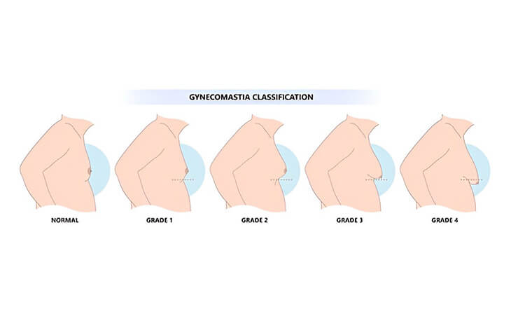 Gynecomastia Surgery