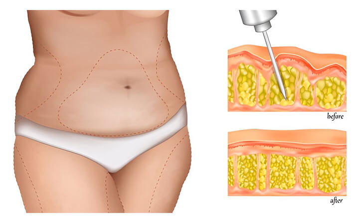 Liposuction Surgery