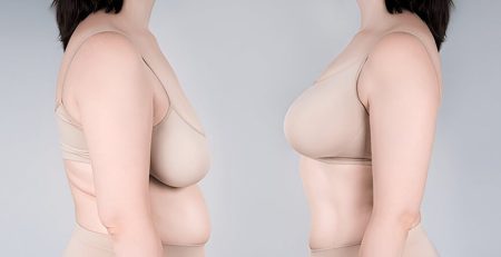 breast reduction surgery