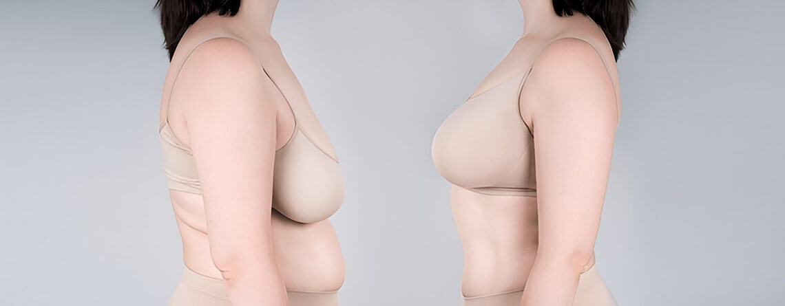 breast reduction surgery