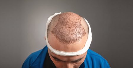 Hair Transplant