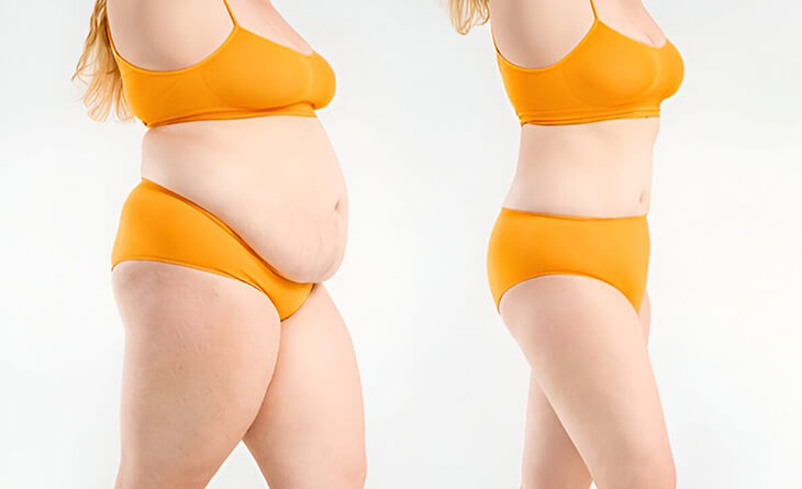 tummy tuck surgery