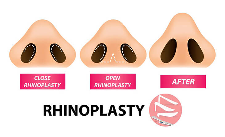 Rhinoplasty Surgery