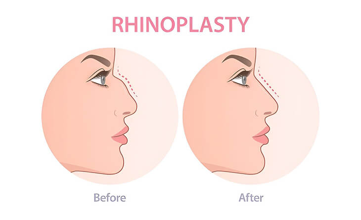 Rhinoplasty Surgery