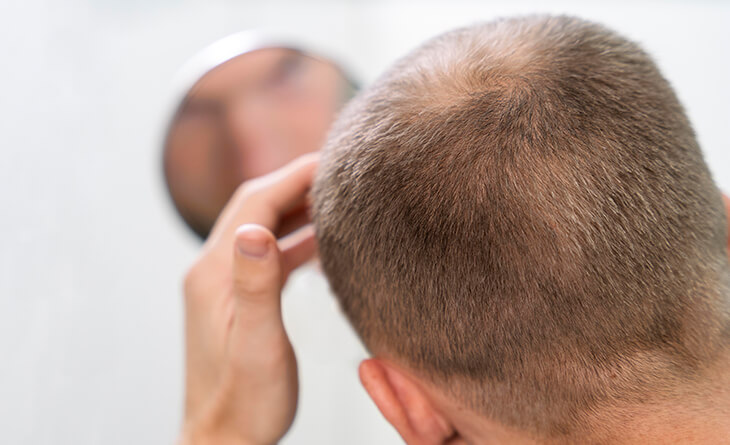 Hair Transplant in India