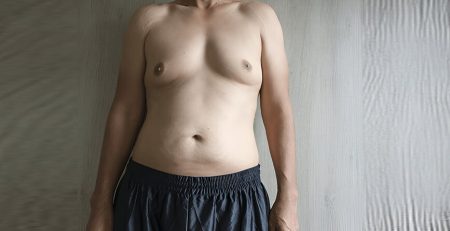 gynecomastia surgery