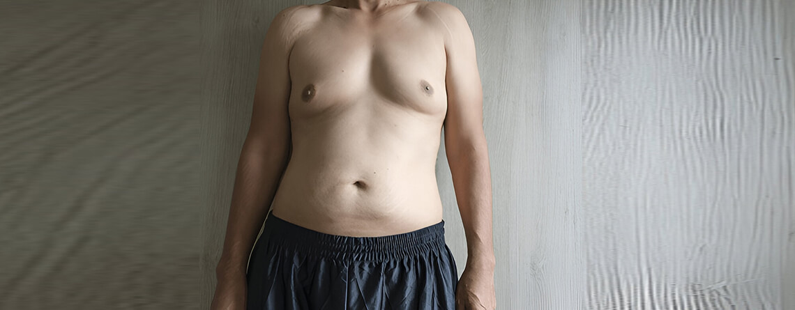 gynecomastia surgery