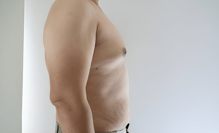 gynecomastia surgery