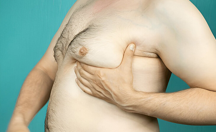 gynecomastia surgery