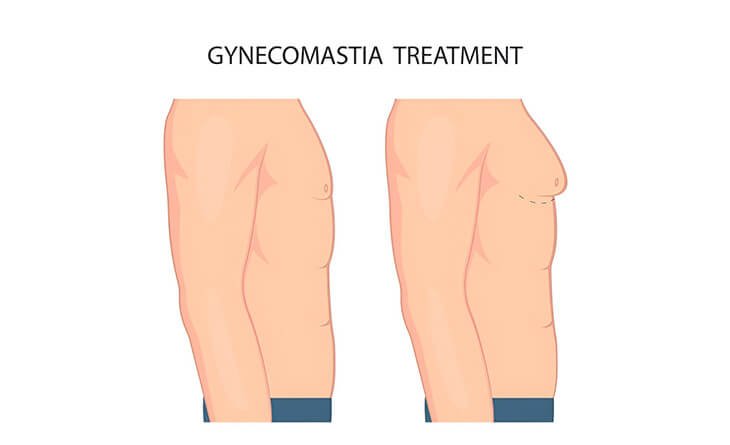 gynecomastia surgery