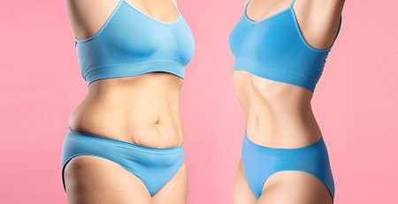 Tummy Tuck Surgery