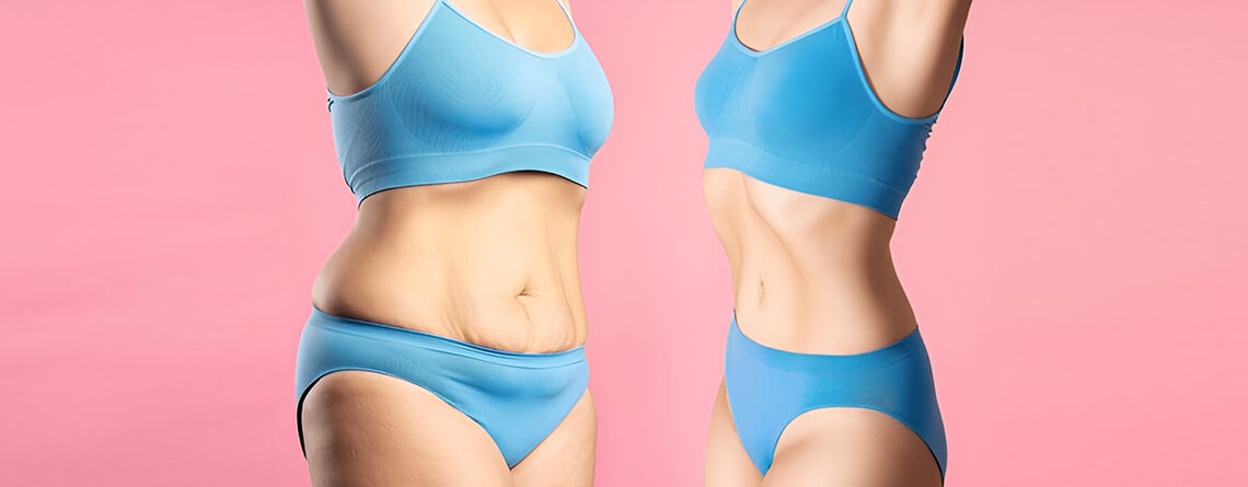 Tummy Tuck Surgery