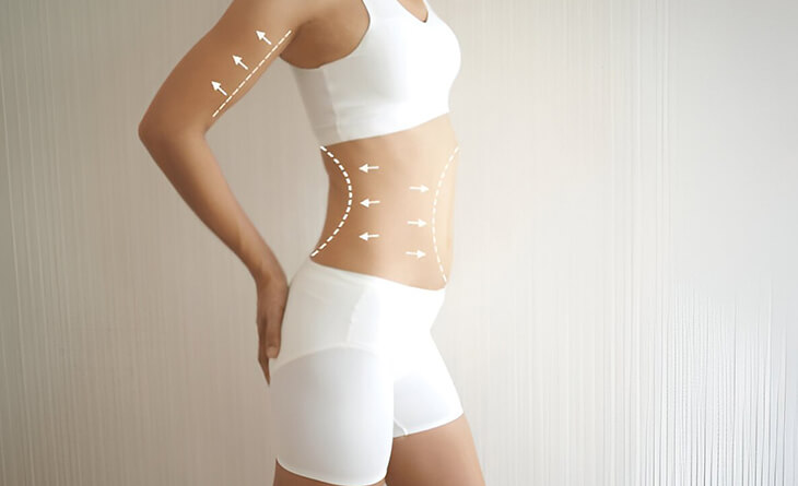 Liposuction surgery