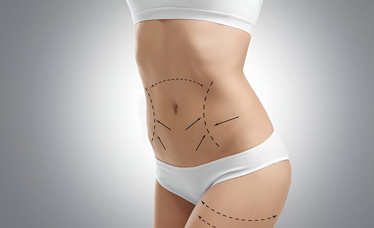 Liposuction surgery