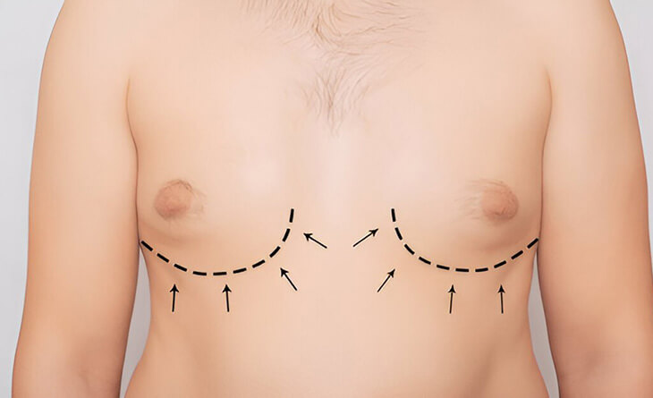 Gynecomastia surgery