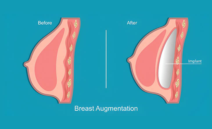 Breast Augmentation Surgery