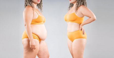 Liposuction Surgery