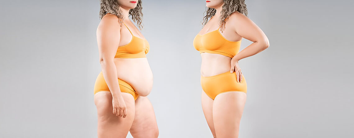 Liposuction Surgery