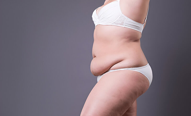 Liposuction Surgery