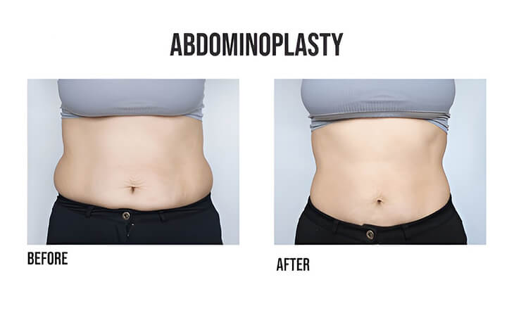 Tummy Tuck Surgery